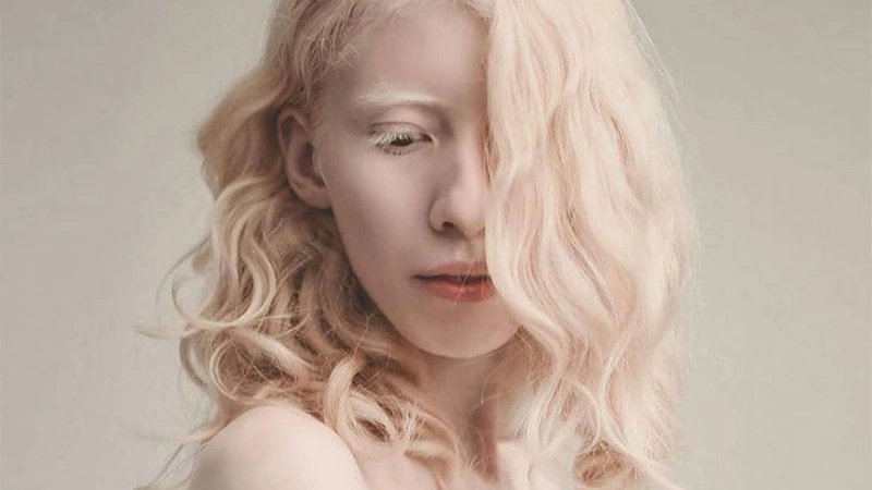 Người bạch tạng cần lưu ý gì khi sinh hoạt