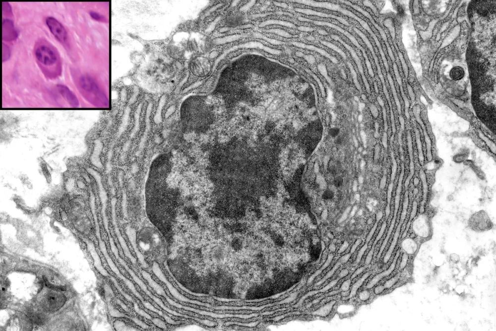 Hình ảnh các bệnh liên quan đến bộ máy Golgi ở người