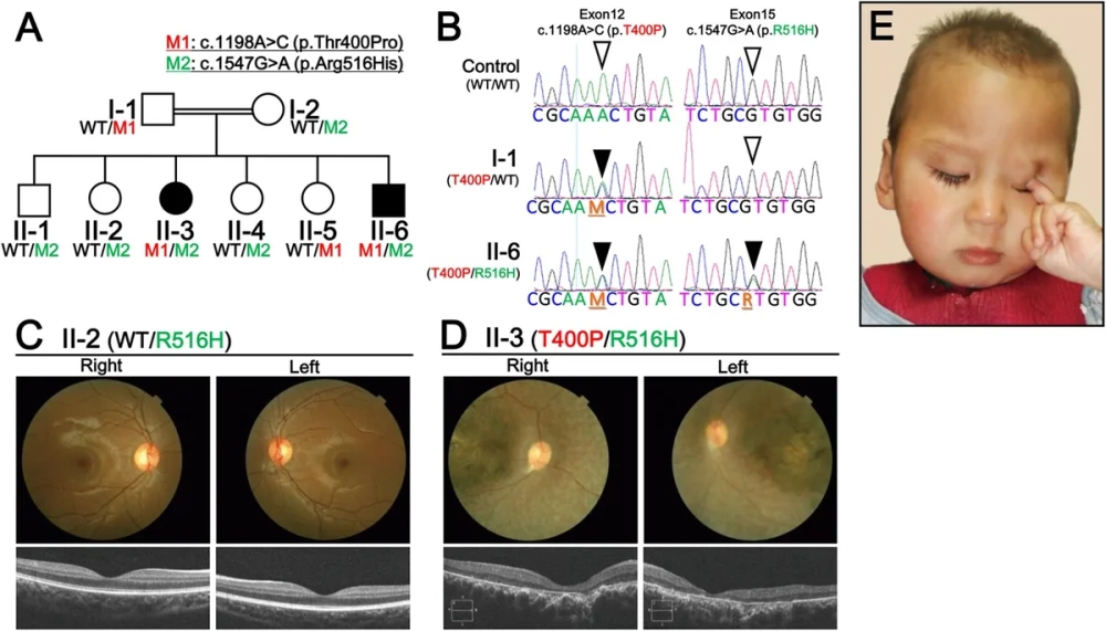 Minh họa đột biến thay thế cặp nucleotit dẫn đến biến đổi protein
